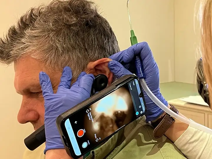 Microsuction norfolk